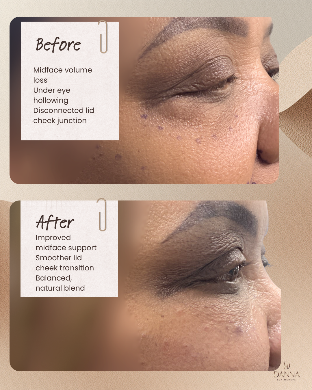 Under-Eye Harmonisation at Danna Lux Medspa