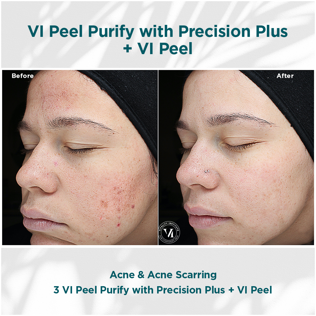 ToxBooster Treatment result 2